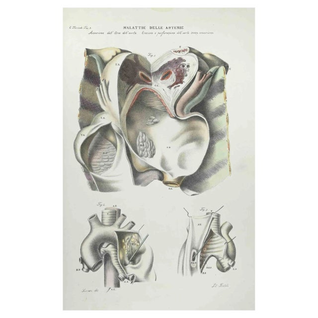 Ottavio Muzzi, Diseases of the Arteries, Lithograph, 1843 For Sale