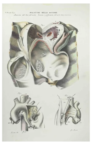 Ottavio Muzzi, Diseases of the Arteries, Lithograph, 1843