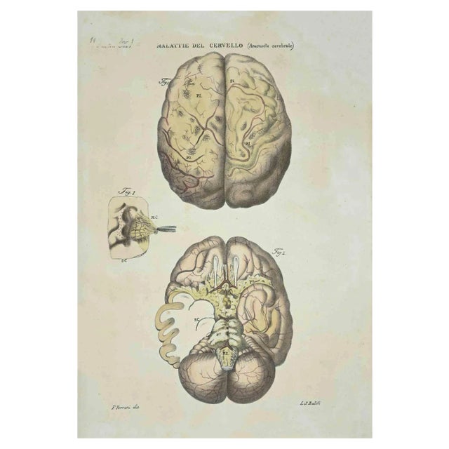 Ottavio Muzzi, Brain Diseases, Lithograph, 1843 For Sale