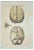 Ottavio Muzzi, Brain Diseases, Lithograph, 1843 For Sale