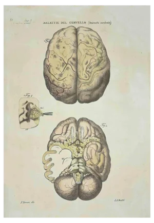 Ottavio Muzzi, Brain Diseases, Lithograph, 1843