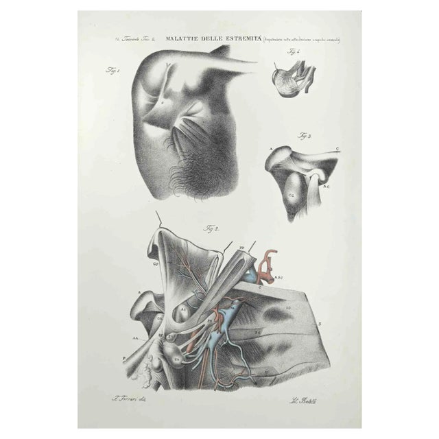 Ottavio Muzzi, Diseases of the Extremities, Lithograph, 1843 For Sale