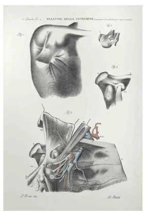 Ottavio Muzzi, Diseases of the Extremities, Lithograph, 1843