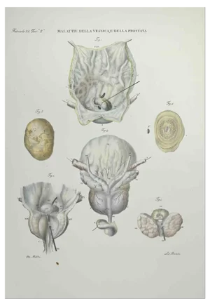 Ottavio Muzzi, Bladder and Prostate Diseases, Lithograph, 1843
