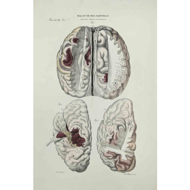 Brain Diseases is a lithograph hand colored by Ottavio Muzzi for the edition of Antoine Chazal,Human Anatomy, Printers...