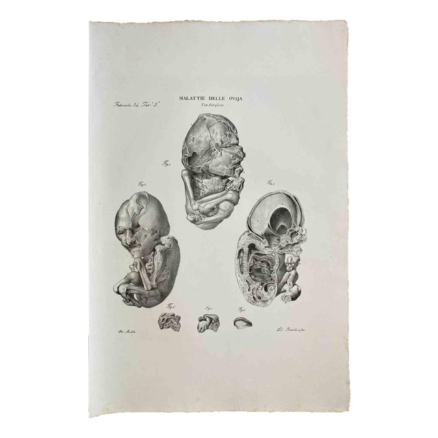 Ottavio Muzzi, Diseases of the Ovary, Lithograph, 1843 For Sale