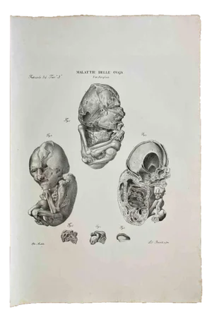 Ottavio Muzzi, Diseases of the Ovary, Lithograph, 1843