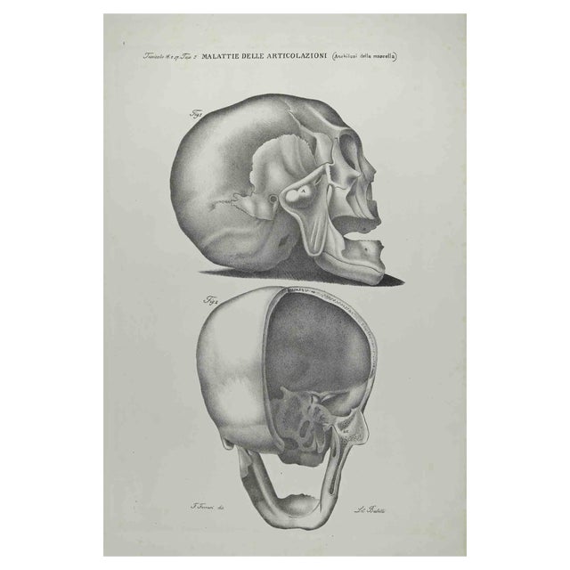 Ottavio Muzzi, Joint Diseases, Lithograph, 1843 For Sale