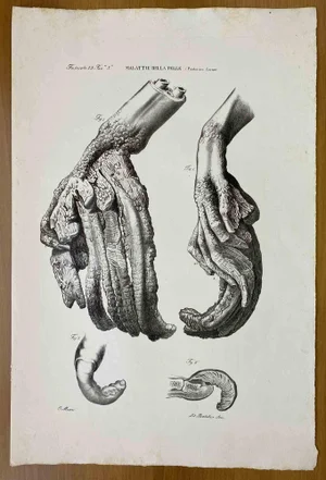 Ottavio Muzzi, Skin Diseases, Lithograph, 1843