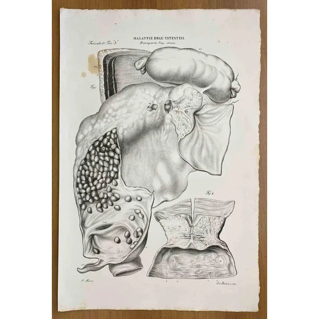 Intestinal Diseases is a lithograph hand colored by Ottavio Muzzi for the edition of Antoine Chazal, Human Anatomy,...