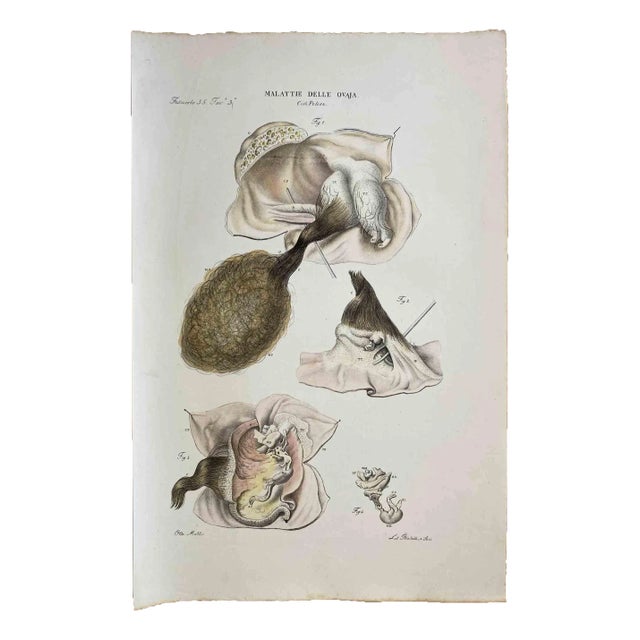 Ottavio Muzzi, Diseases of the Ovary, Lithograph, 1843 For Sale