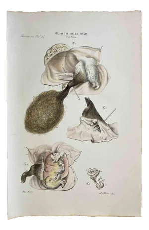 Ottavio Muzzi, Diseases of the Ovary, Lithograph, 1843