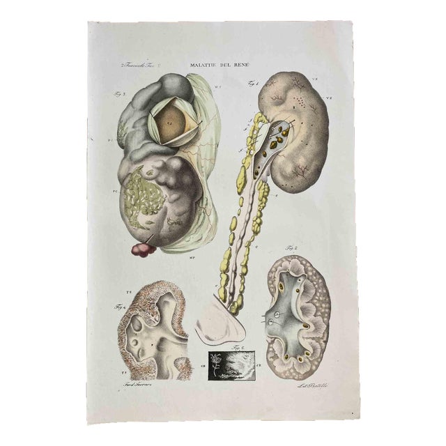 Ottavio Muzzi, Kidney Diseases, Lithograph, 1843 For Sale