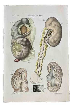 Ottavio Muzzi, Kidney Diseases, Lithograph, 1843