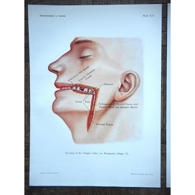 This pair of antique lithographs depict the surgical excision of a tongue. It was printed in the U.S.A. in 1906. Whether...