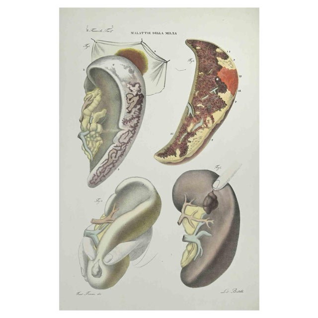 Ottavio Muzzi, Liver Diseases, Lithograph, 1843 For Sale