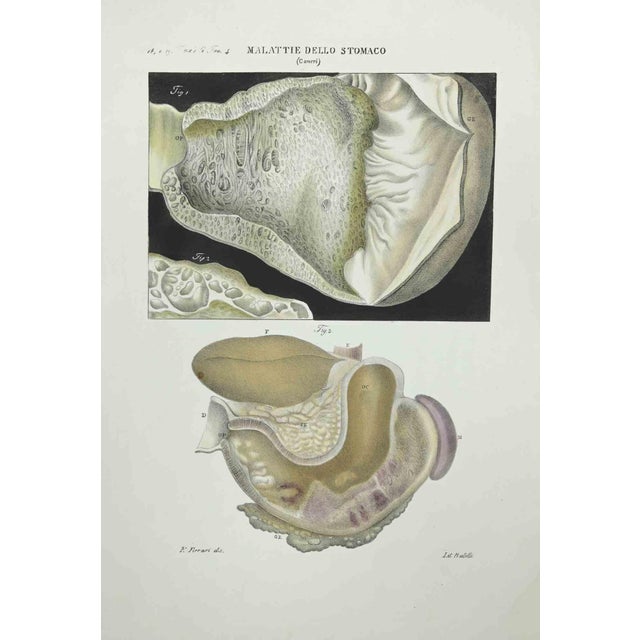 Stomach Diseases is a lithograph hand colored by Ottavio Muzzi for the edition of Antoine Chazal, Human Anatomy, Printers...