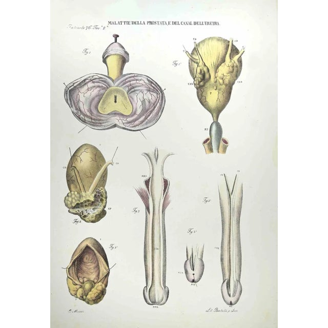 Diseases of the Prostate and the Urethra Canal is a lithograph hand colored by Ottavio Muzzi for the edition of Antoine...