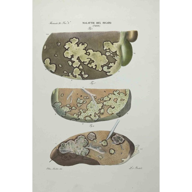 Liver Diseases is a lithograph hand colored by Ottavio Muzzi for the edition of Antoine Chazal,Human Anatomy, Printers...