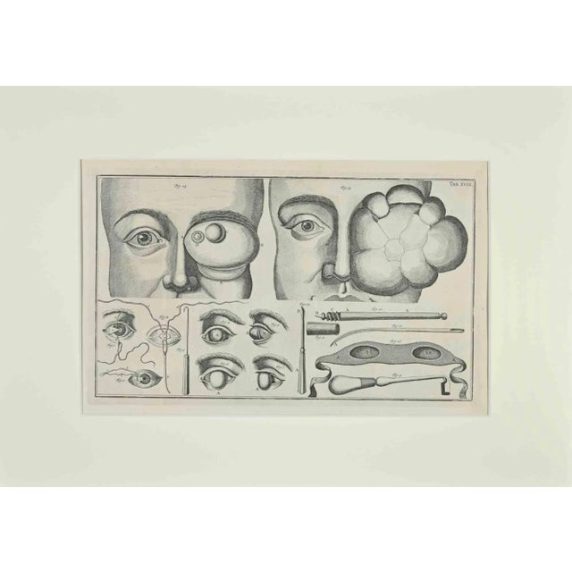 Lorenz Heister, Surgery of the Eye, Etching, 1750 For Sale - Image 3 of 3