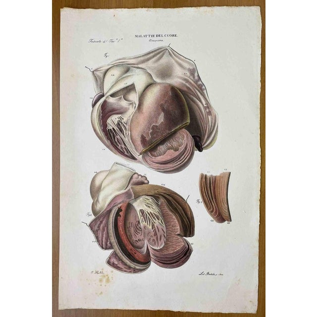 Heart Diseases is a lithograph hand colored by Ottavio Muzzi for the edition of Antoine Chazal, Human Anatomy, Printers...