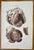 Heart Diseases is a lithograph hand colored by Ottavio Muzzi for the edition of Antoine Chazal, Human Anatomy, Printers...