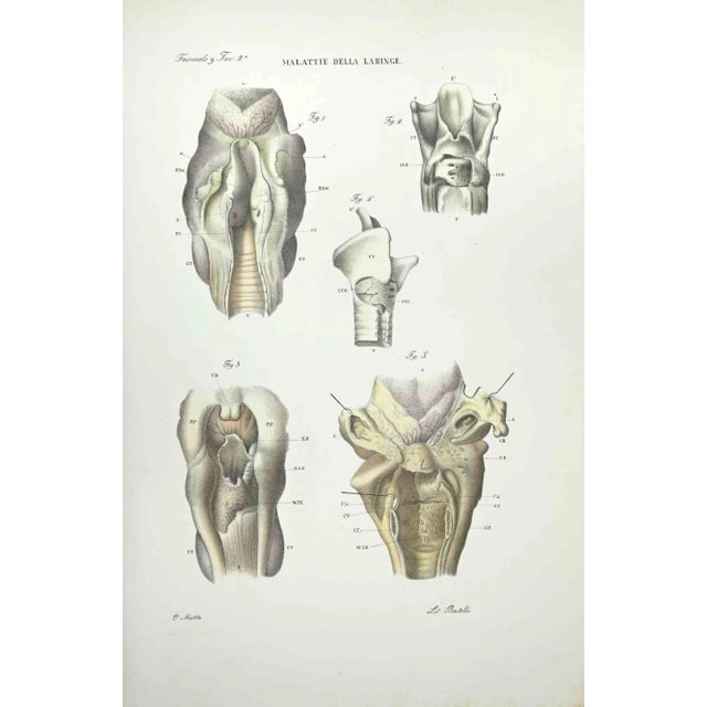 Brain Diseases is a lithograph hand colored by Ottavio Muzzi for the edition of Antoine Chazal, Human Anatomy, Printers...