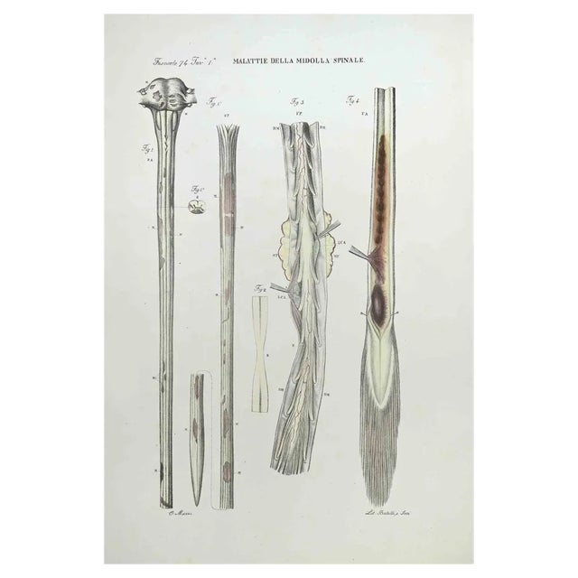 Ottavio Muzzi, Diseases of the Brain and Spinal Cord, Lithograph, 1843 For Sale
