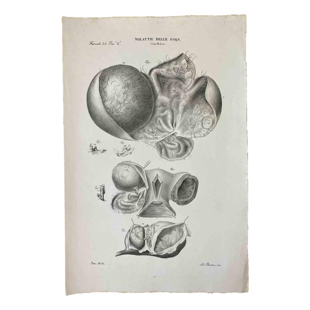 Ottavio Muzzi, Diseases of the Ovary, Lithograph, 1843 For Sale