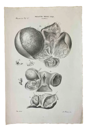 Ottavio Muzzi, Diseases of the Ovary, Lithograph, 1843