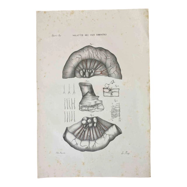 Ottavio Muzzi, Diseases of the Lymphatic Vessels, Lithograph, 1843 For Sale