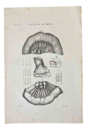 Ottavio Muzzi, Diseases of the Lymphatic Vessels, Lithograph, 1843