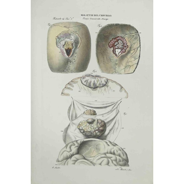 Brain Diseases is a lithograph hand colored by Ottavio Muzzi for the edition of Antoine Chazal, Human Anatomy, Printers...