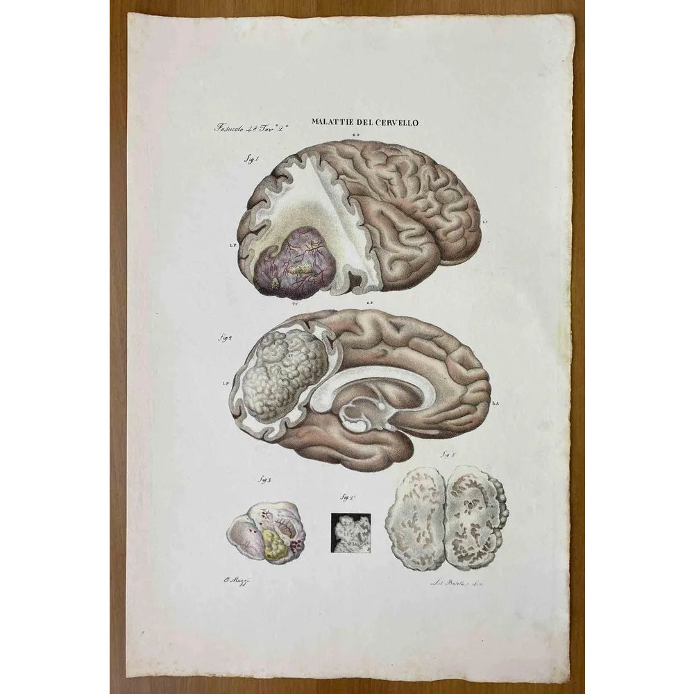 Ottavio Muzzi, Brain Disease, Lithograph, 1843 | Chairish
