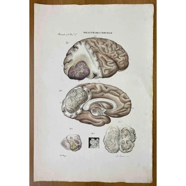 Ottavio Muzzi, Brain Disease, Lithograph, 1843 For Sale