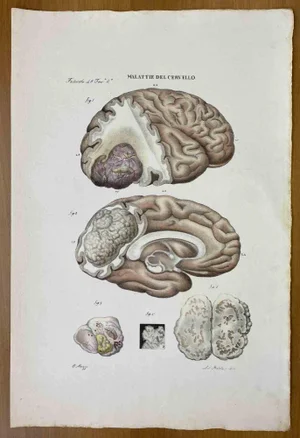 Ottavio Muzzi, Brain Disease, Lithograph, 1843