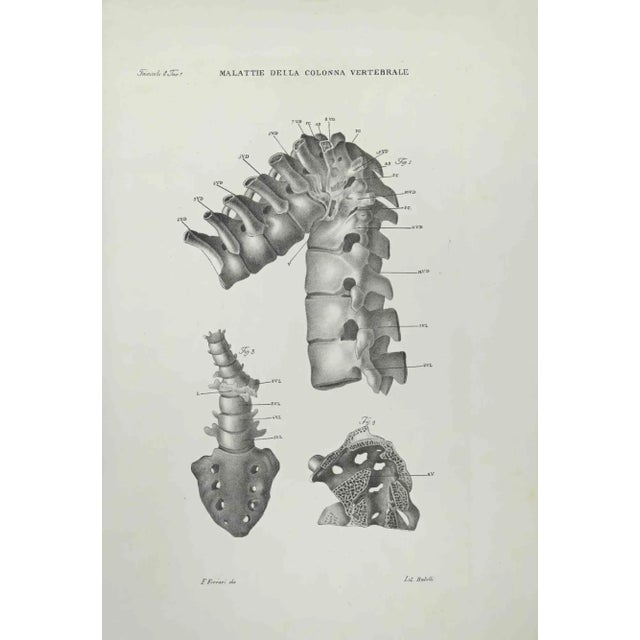 Vertebral Column Diseases is a lithograph hand colored by Ottavio Muzzi for the edition of Antoine Chazal, Human Anatomy,...
