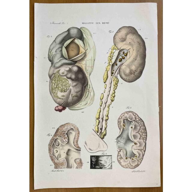 Kidney Diseases is a lithograph hand colored by Ottavio Muzzi for the edition of Antoine Chazal, Human Anatomy, Printers...