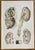 Kidney Diseases is a lithograph hand colored by Ottavio Muzzi for the edition of Antoine Chazal, Human Anatomy, Printers...