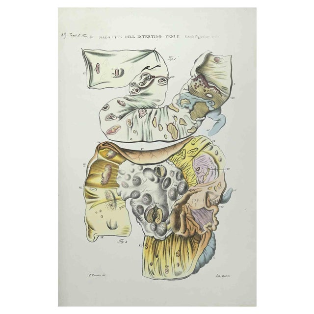 Ottavio Muzzi, Small Intestine Diseases, Lithograph, 1843 For Sale
