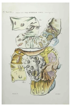 Ottavio Muzzi, Small Intestine Diseases, Lithograph, 1843