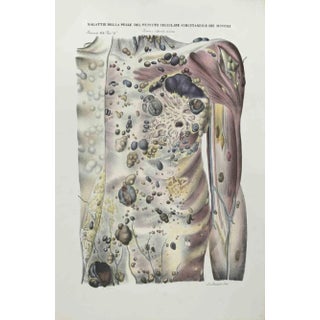 Ottavio Muzzi, Skin Diseases of Subcutaneous Cell Tissue and Muscles, Lithograph, 1843 For Sale