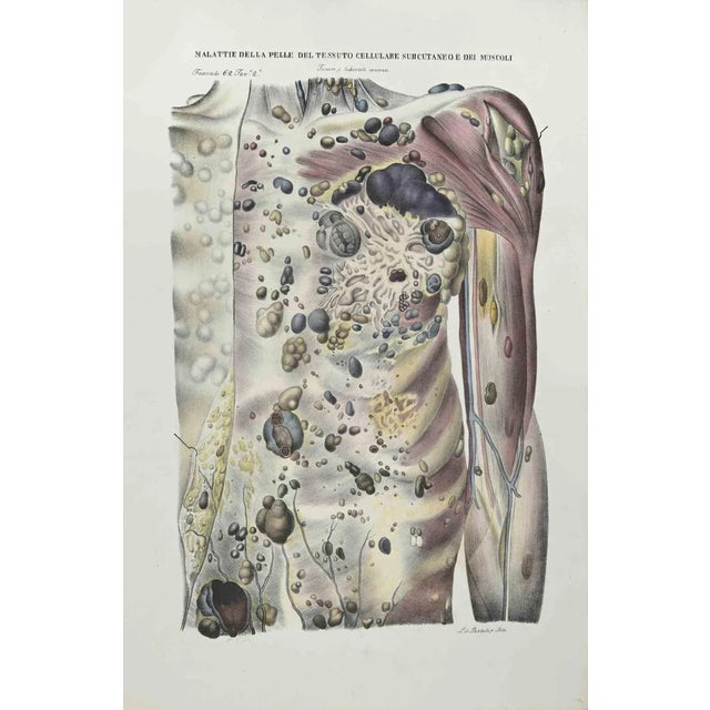 Ottavio Muzzi, Skin Diseases of Subcutaneous Cell Tissue and Muscles, Lithograph, 1843 For Sale