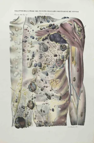 Ottavio Muzzi, Skin Diseases of Subcutaneous Cell Tissue and Muscles, Lithograph, 1843