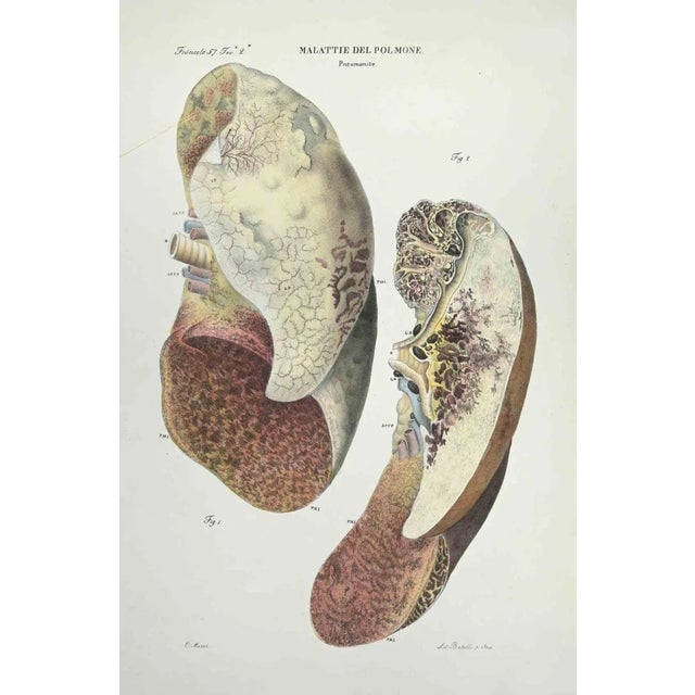 Lung Diseases is a lithograph hand colored by Ottavio Muzzi for the edition of Antoine Chazal,Human Anatomy, Printers...