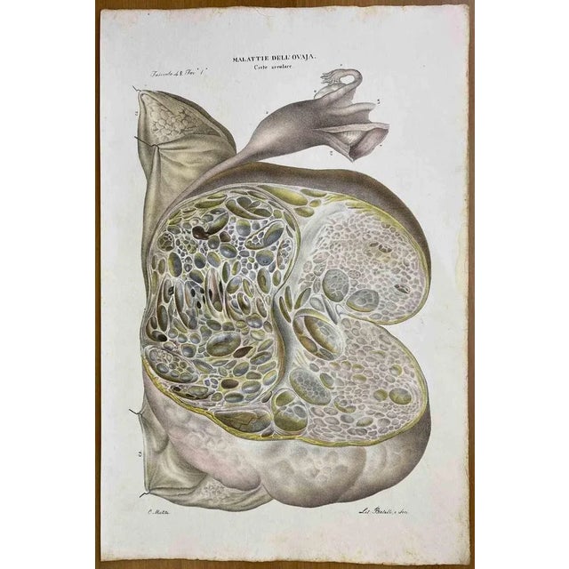 Diseases of the Ovary is a lithograph hand colored by Ottavio Muzzi for the edition of Antoine Chazal, Human Anatomy,...