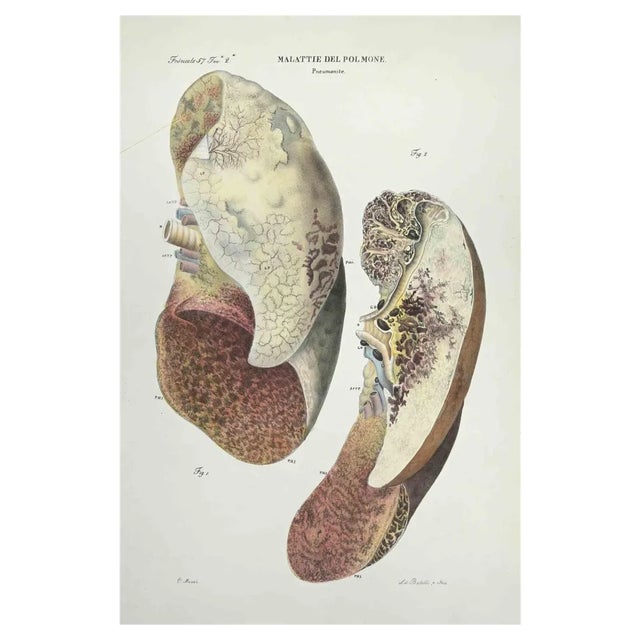 Ottavio Muzzi, Lung Diseases, Lithograph, 1843 For Sale