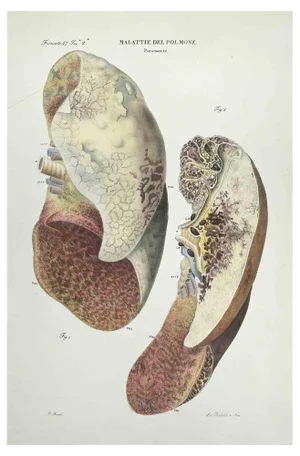 Ottavio Muzzi, Lung Diseases, Lithograph, 1843