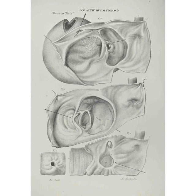 Stomach Diseases is a lithograph hand colored by Ottavio Muzzi for the edition of Antoine Chazal, Human Anatomy, Printers...