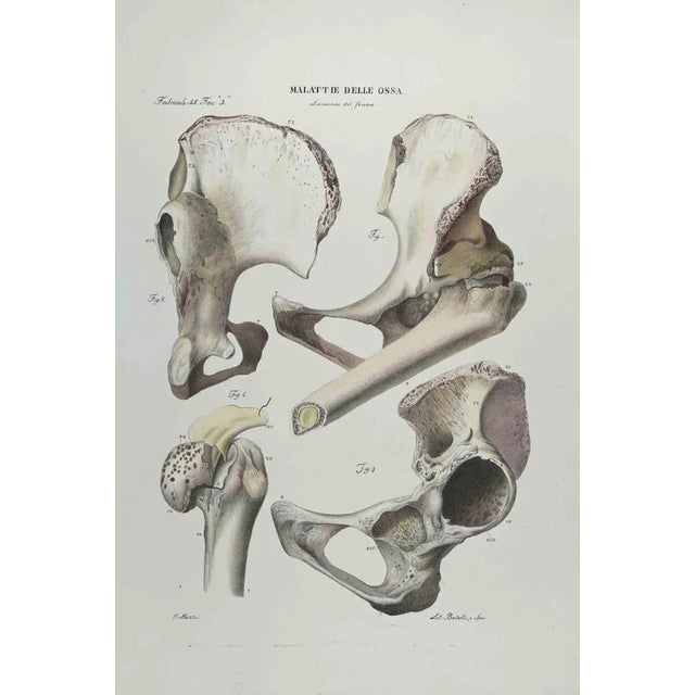 Bone Disease is a lithograph hand colored by Ottavio Muzzi for the edition of Antoine Chazal, Human Anatomy, Printers...